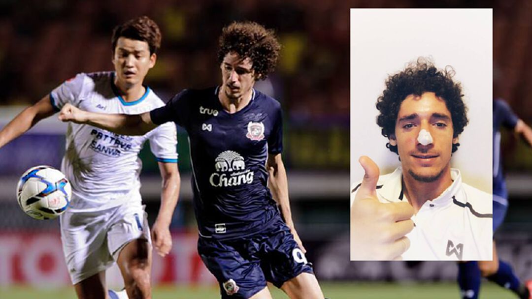 ดั้งยังโด่ง!! โรมูโล่เย็บจมูก 2 เข็มสังเวยแข้งวัฒนา